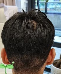 -大麦微针植发丨全国连锁