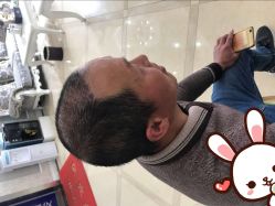 -大麦微针植发丨全国连锁