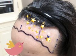 -大麦微针植发全国连锁