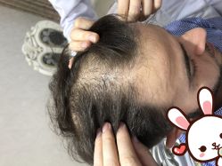 -大麦微针植发丨全国连锁