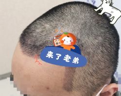 -大麦微针植发全国连锁