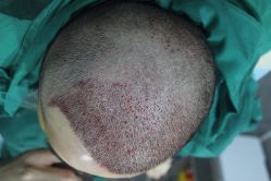 点击看大图 -大麦微针植发丨全国连锁