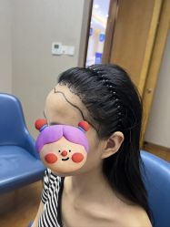 -大麦微针植发全国连锁