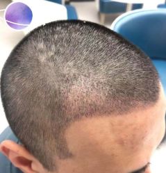 -大麦微针植发丨全国连锁