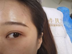 体验后-JUVA郑州欧华医疗美容医院