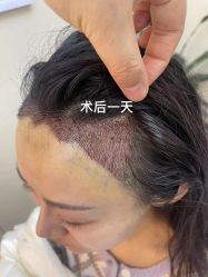 体验后-大麦微针植发全国连锁