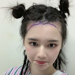 -碧莲盛·不剃发植发