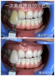 光SPA牙齿美白-光SPA科技美肤