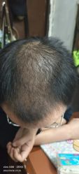 -大麦微针植发丨全国连锁