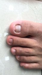 点击看大图 -德哥灰指甲脚气甲沟炎跖疣护理