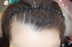 -大麦微针植发全国连锁