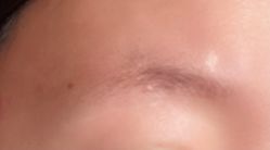 体验后-深圳美莱医疗美容医院