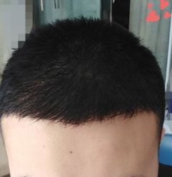 -大麦微针植发丨全国连锁