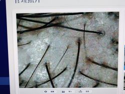 体验后-大麦微针植发丨全国连锁