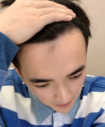 -大麦微针植发全国连锁