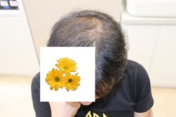 -大麦微针植发丨全国连锁