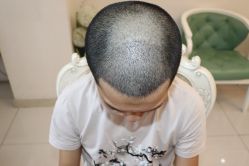 -大麦微针植发丨全国连锁