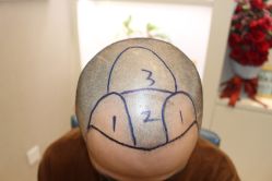 -大麦微针植发丨全国连锁