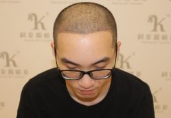 -大麦微针植发全国连锁