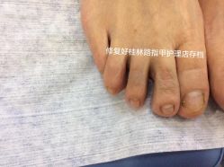 -德哥灰指甲脚气甲沟炎跖疣护理