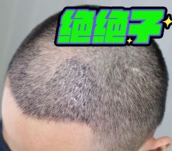 -大麦微针植发丨全国连锁