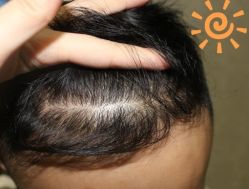 -大麦微针植发丨全国连锁