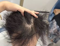 -大麦微针植发全国连锁