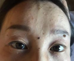 体验前-爱莎扁平疣·汗管瘤·斑痣中心