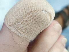 -祖传修脚甲沟炎灰指甲鸡眼