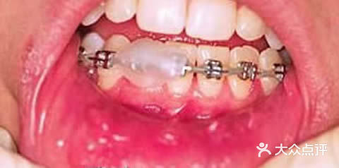 帮你轻松度过矫正器的好物分享[糖果]