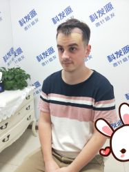 点击看大图 -大麦微针植发丨全国连锁