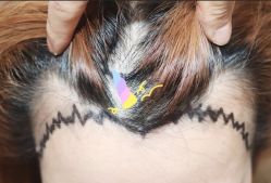 -大麦微针植发全国连锁