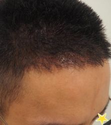 -大麦微针植发丨全国连锁