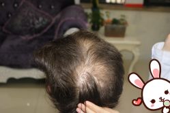 -大麦微针植发丨全国连锁