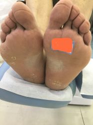 -派恩宜灰指甲鸡眼嵌甲手足癣