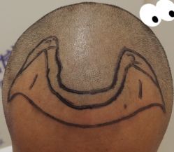 -大麦微针植发全国连锁