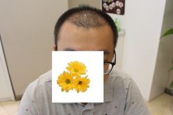 -大麦微针植发丨全国连锁