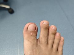 -新甲连锁灰指甲·甲沟炎·修脚(爱联店)