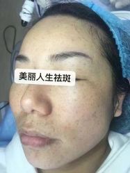 -爱莎扁平疣·汗管瘤·斑痣中心