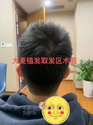 -大麦微针植发全国连锁