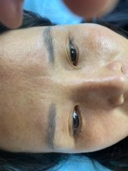 体验后-爱莎扁平疣·汗管瘤·斑痣中心