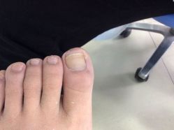 -德哥灰指甲脚气甲沟炎跖疣护理