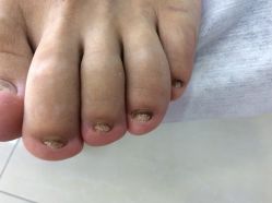 -德哥灰指甲脚气甲沟炎跖疣护理