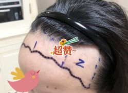 -大麦微针植发全国连锁