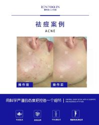 -靓芙泉专研痘痘肌