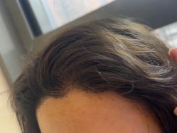 -碧莲盛·不剃发植发