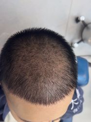 -大麦微针植发全国连锁