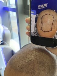 -碧莲盛·不剃发植发