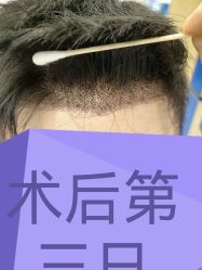 -大麦微针植发全国连锁