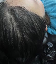 -碧莲盛·不剃发植发